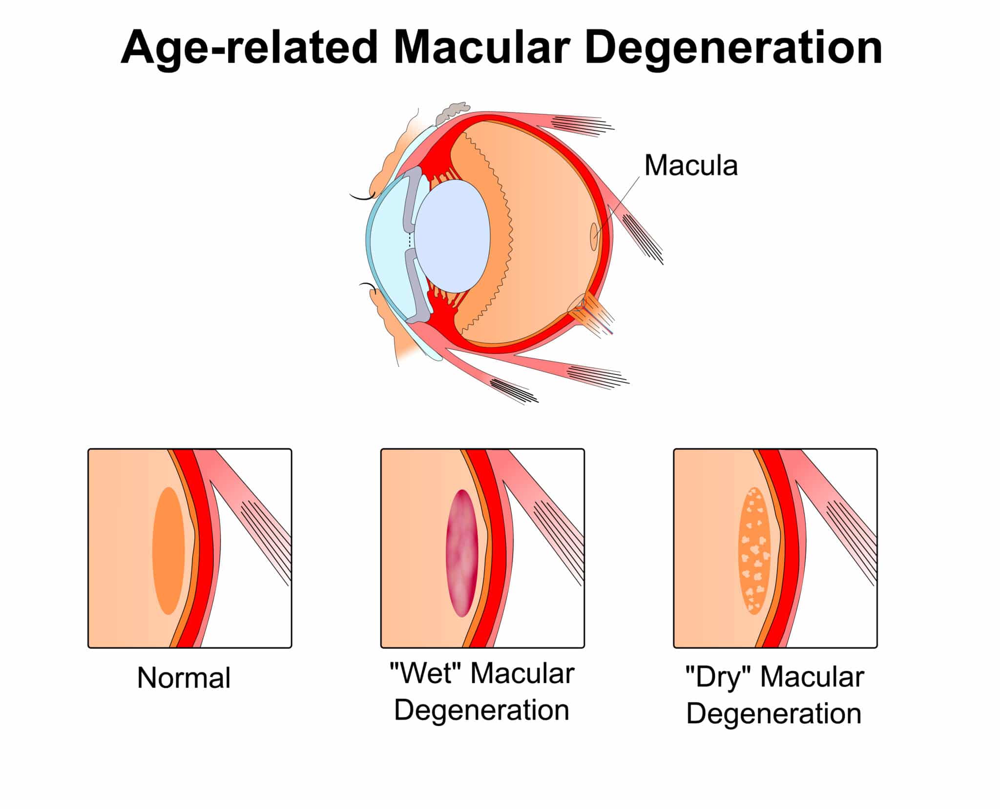 age-related macular degeneration