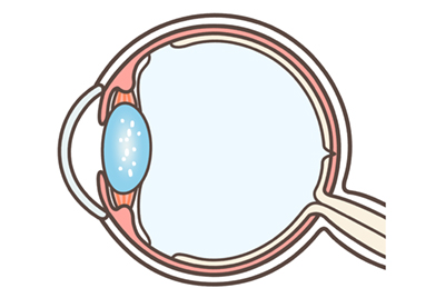 Cataract diagram