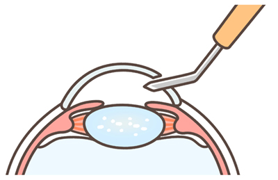 Cataract surgery step diagram