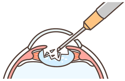Cataract surgery step diagram