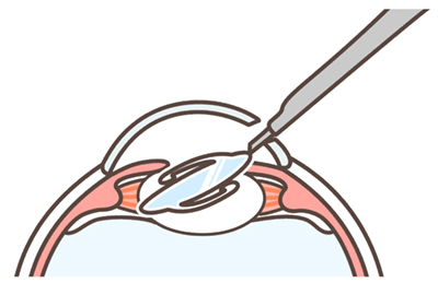 Cataract Surgery step illustration