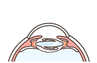 Cataract surgery step diagram