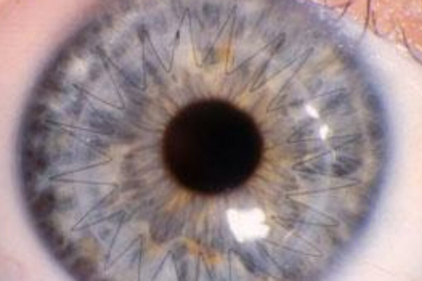 Corneal cross linking