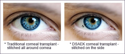 DSAEK Eye Surgery