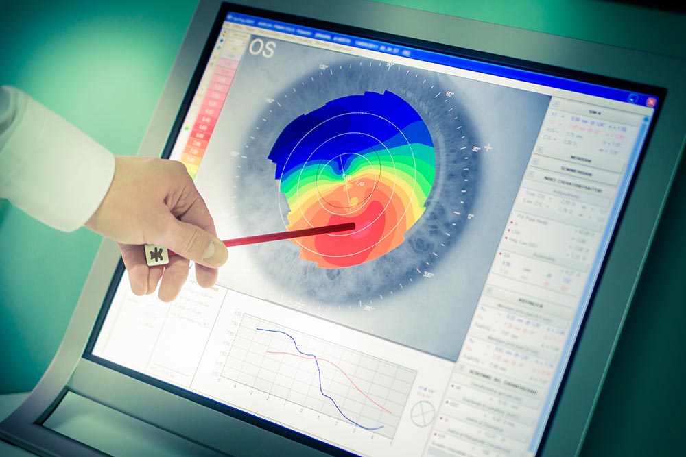 DSEK Cornea Scan