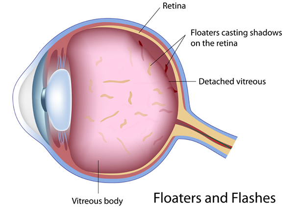 Diagram explaining flashes and floaters in the eye