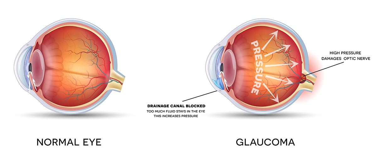 Glaucoma diagram