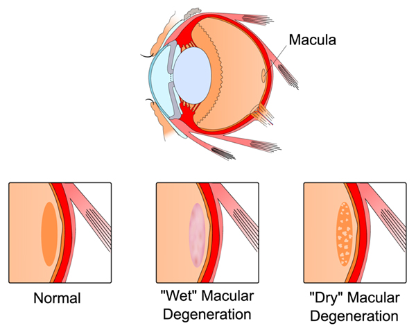 Macular degeneration diagram