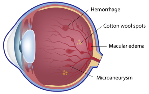 Diagram of an eye afflicted with Non Proliferative Retinopathy