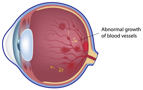 Diagram of an eye affected by Proliferative Retinopathy