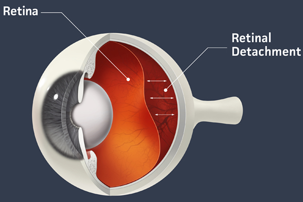 Diagram illustrating a retinal detachment
